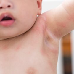 Suchá pokožka a opruzeniny už vás nemusí trápit. Praktické tipy od odborníků